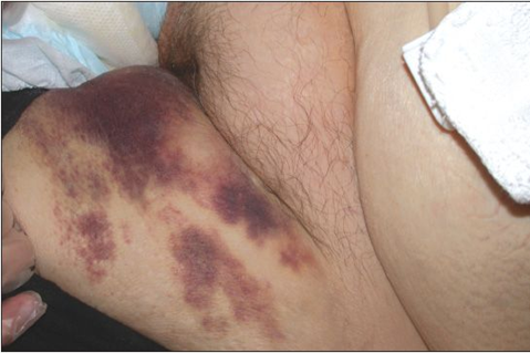 Hình ảnh cho thấy bầm máu (ecchymosis) ở vùng cánh tay, biểu hiện bằng mảng xuất huyết lớn dưới da có màu tím sẫm, kích thước trên 1 cm và ranh giới không đều.