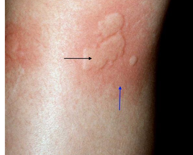 Hình ảnh cho thấy tổn thương mày đay (wheal) trên da, biểu hiện bằng vùng da nổi cao, phù nề, màu hồng nhạt trên nền ban đỏ