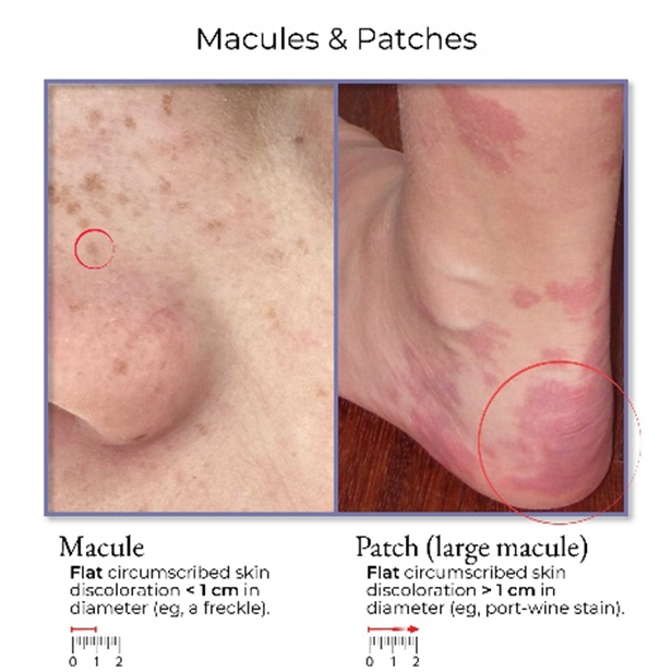 Hình minh họa sự khác biệt giữa dát (macule) và mảng dát (patch) trong da liễu