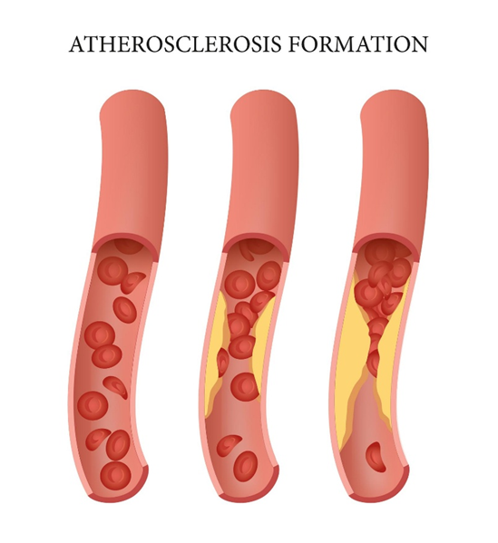 Hình minh họa quá trình hình thành xơ vữa động mạch (atherosclerosis formation) theo thời gian trong nhồi máu não. 