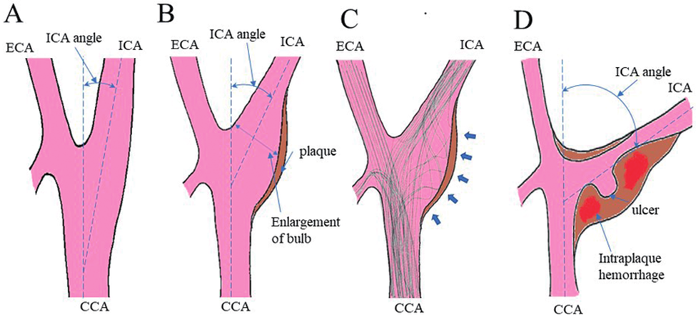 Hình minh họa sự tiến triển của xơ vữa động mạch cảnh tại vị trí chia mạch từ trạng thái bình thường đến khi xuất hiện biến chứng. A)Bình thường B) Hình thành mảng xơ vữa C) Rối loạn dòng chảy D) Biến chứng mảng xơ vữa
Nguồn: Takai, H., Matsubara, S., Minami-Ogawa, Y., et al. (2023). Association between carotid bifurcation angle and vulnerable plaque volume using black-blood magnetic resonance imaging. Journal of Stroke and Cerebrovascular Diseases. 