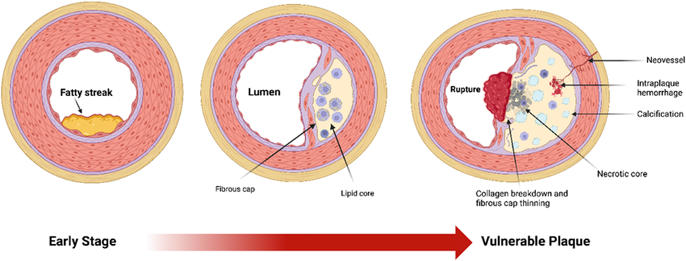Sơ đồ ba giai đoạn chính của sự phát triển mảng xơ vữa động mạch, bắt đầu với sự hình thành vệt mỡ giai đoạn đầu, đến giai đoạn dễ bị tổn thương nhất