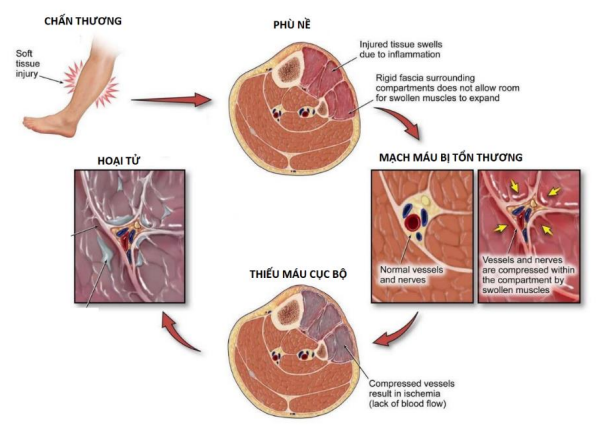 Hội chứng chèn ép khoang (CEK): Từ nhận biết lâm sàng đến xử trí cấp cứu image 52