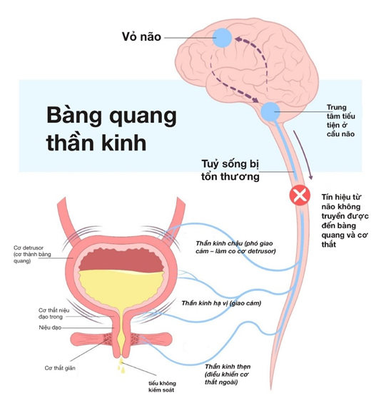 Hình minh họa tổng quan cơ chế bàng quang thần kinh khi có tổn thương, làm gián đoạn đường dẫn truyền thần kinh giữa não và bàng quang.
