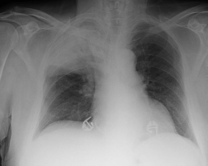 X-quang ngực cho thấy vùng đông đặc đồng nhất ở một thùy phổi trên bên phải, gợi ý viêm phổi thùy