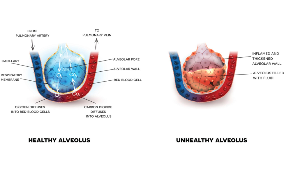 Hình minh họa sự khác biệt giữa phế nang bình thường (bên trái) và phế nang viêm và chứa dịch (bên phải)