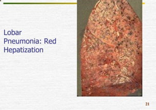 Hình này minh họa giai đoạn gan hóa đỏ (red hepatization) trong viêm phổi thùy.