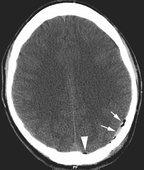 Hình ảnh CT đầu không cản quang hướng trục cho thấy một tập hợp dịch tăng đậm đặc hình lưỡi liềm trong khoang dưới màng cứng đỉnh-chẩm trái, phù hợp với tụ máu dưới màng cứng cấp tính (mũi tên)