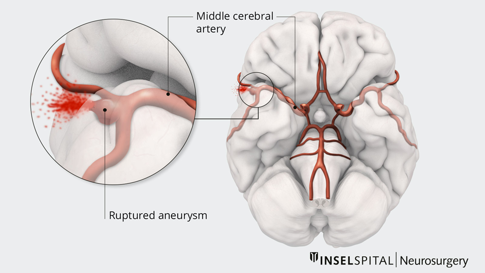 Hình minh họa vỡ túi phình mạch não tại động mạch não giữa (middle cerebral artery). Khi túi phình vỡ, máu từ động mạch phun vào khoang dưới nhện, lan theo các rãnh não và bể nền, gây xuất huyết dưới nhện.