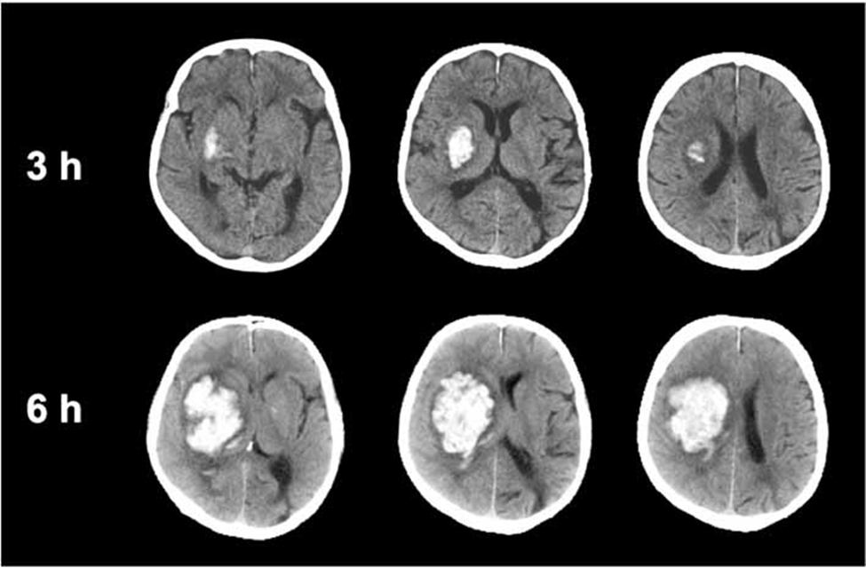 Hình ảnh xuất huyết trong nhu mô máu mở rộng. Chụp CT nối tiếp, 3 và 6 giờ sau khi khởi phát triệu chứng, cho thấy sự mở rộng đáng kể của xuất huyết não nguyên phát 