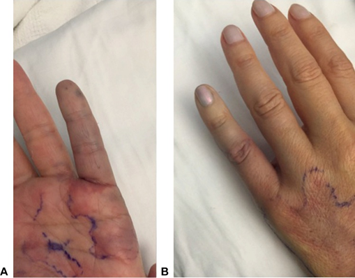 Hình ảnh cho thấy thiếu máu cục bộ đầu chi do tắc vi mạch