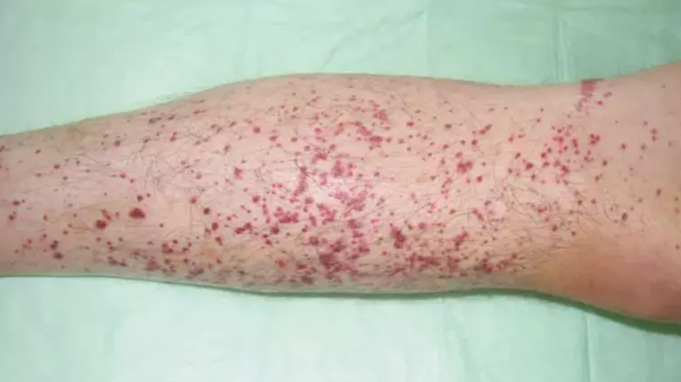 Hình ảnh cho thấy ban xuất huyết dạng chấm ở cẳng chân