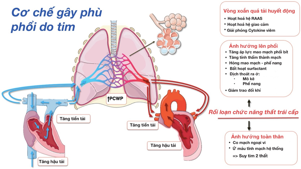 Cơ chế gây phù phổi trong suy tim: Nguyên nhân và các giai đoạn trong cơ chế bệnh sinh Hình ảnh tổng quan về cơ chế gây phù phổi do tim