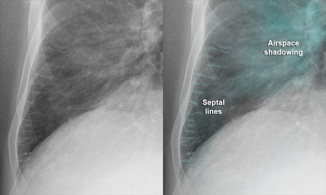 Cơ chế gây phù phổi trong suy tim: Nguyên nhân và các giai đoạn trong cơ chế bệnh sinh Hình ảnh đường Kerley B: là các đường mờ ngắn, nằm ngang ở vùng đáy phổi trên X-quang ngực, thường gặp trong phù kẽ phổi – đặc biệt là phù phổi do tim. Nguồn: Tetaj, N., et al. (2026). Respiratory support in cardiogenic pulmonary edema. Journal of Cardiovascular Development and Disease, 13(1), 54