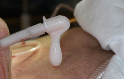 Cơ chế gây phù phổi trong suy tim: Nguyên nhân và các giai đoạn trong cơ chế bệnh sinh image 14