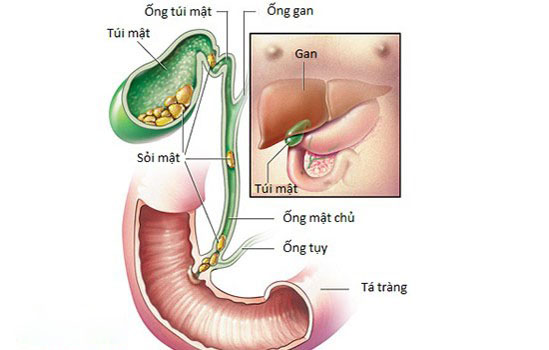 Sỏi túi mật và cú lừa "tẩy sỏi tự nhiên": Khi bàn mổ ngoại khoa là lối thoát an toàn nhất image 18