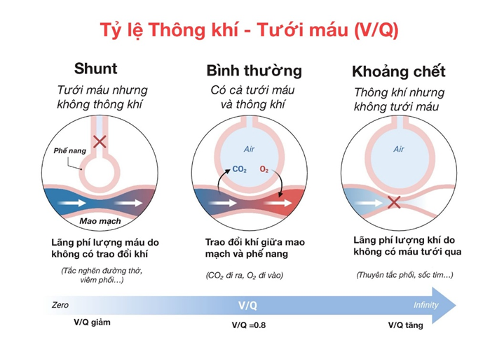 Hình ảnh minh họa rõ ba trạng thái điển hình của V/Q, từ bình thường đến các dạng mất cân bằng.