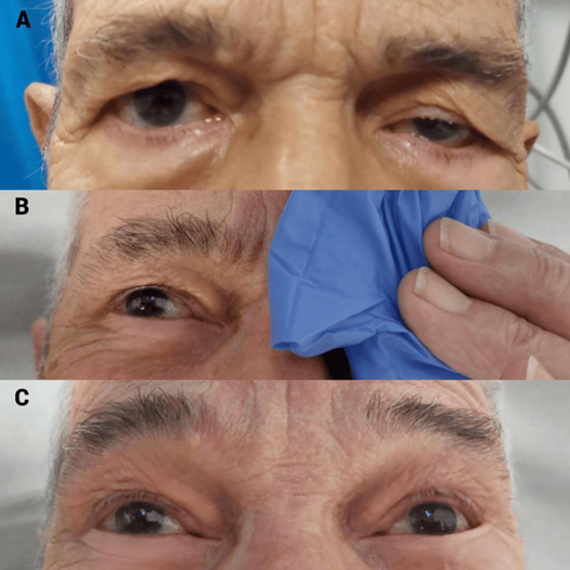 Hình test dương tính khi sụp mi cải thiện sau chườm lạnh, gợi ý mạnh đến nhược cơ. Nguồn: Gilhus, N. E. (2016). Myasthenia gravis. New England Journal of Medicine, 375(26), 2570–2581.