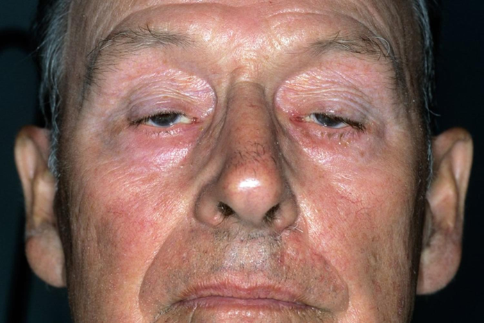 Hình cho thấy một bệnh nhân có yếu cơ mặt rõ rệt, kèm theo khuôn mặt ít biểu cảm. Nguồn: Bae, J. S., Go, S. M., & Kim, B. J. (2020). Clinical features and diagnosis of myasthenia gravis. Journal of Clinical Neurology, 16(3), 365–373.