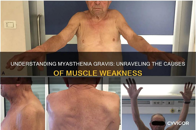 Hình minh họa tình trạng yếu cơ gốc chi, đặc biệt là cơ vai ở bệnh nhân nhược cơ. Ở phần trên, bệnh nhân khi giơ hai tay ra trước cho thấy khả năng duy trì lực kém, tay có xu hướng hạ xuống do mỏi cơ. Nguồn: Gilhus, N. E., Tzartos, S., Evoli, A., Palace, J., Burns, T. M., & Verschuuren, J. (2019). Myasthenia gravis. Nature Reviews Disease Primers, 5(1), 30.