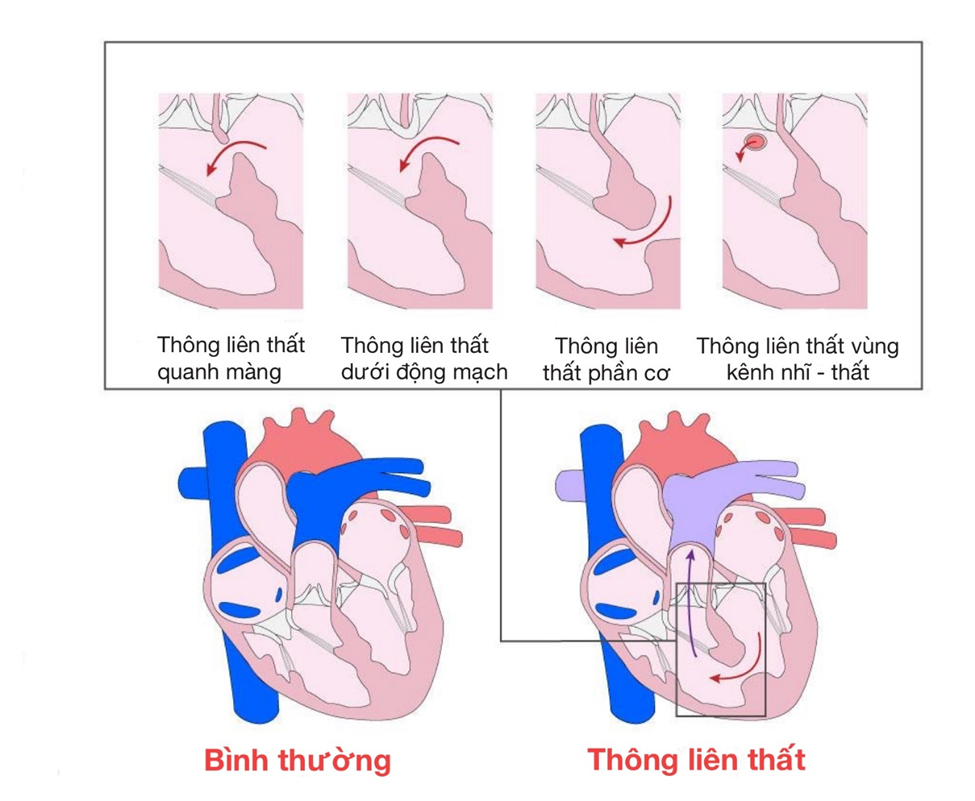 Hình ảnh tổng quan về thông liên thất 