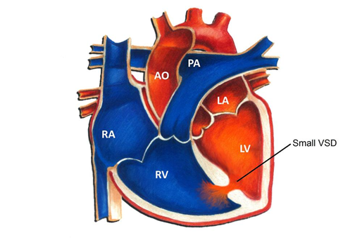 Hình ảnh minh họa shunt liên thất 