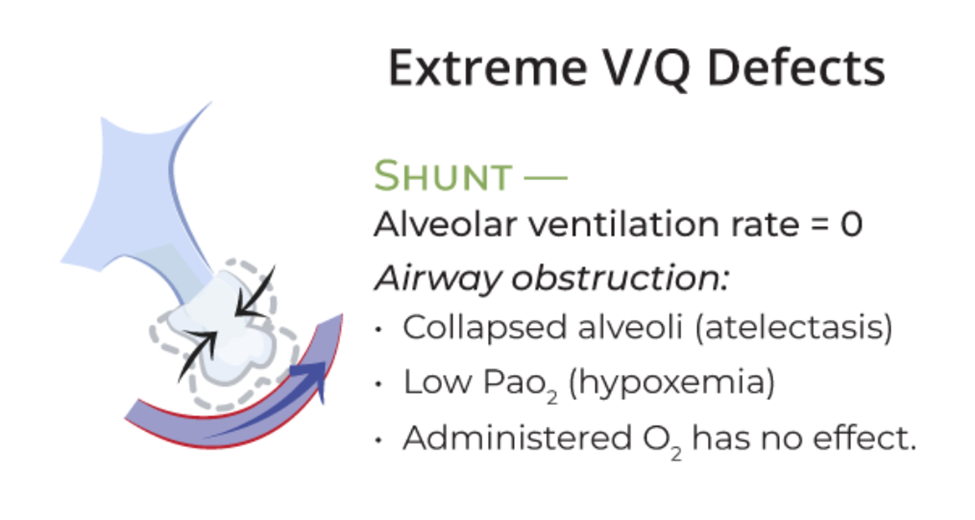 Hình minh họa phế nang không được thông khí do bị xẹp hoặc tắc nghẽn, nhưng máu vẫn tiếp tục chảy qua (Q vẫn có).