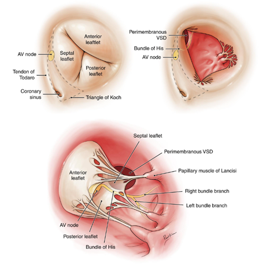 Hình minh họa thông liên thất quanh màng (perimembranous VSD) nằm sát van ba lá và van động mạch chủ, đồng thời rất gần hệ dẫn truyền tim (nút AV, bó His). Nguồn: Kumar, V., Abbas, A. K., & Aster, J. C. (2020). Robbins & Cotran pathologic basis of disease (10th ed.). Elsevier.