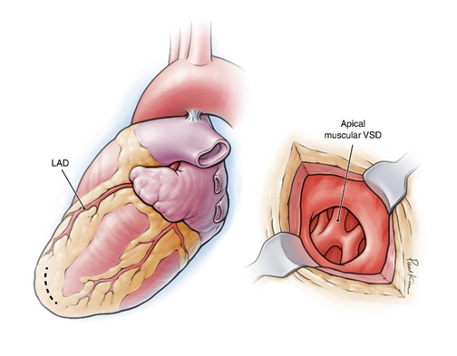 Hình minh họa thông liên thất phần cơ ở vùng mỏm tim (apical muscular VSD).