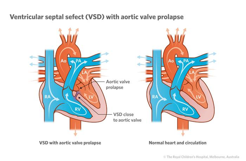 Hình minh họa thông liên thất dưới động mạch kèm sa van động mạch chủ và so sánh với tim bình thường.Nguồn: Park, M. K. (2021). Park’s pediatric cardiology for practitioners (7th ed.). Elsevier.