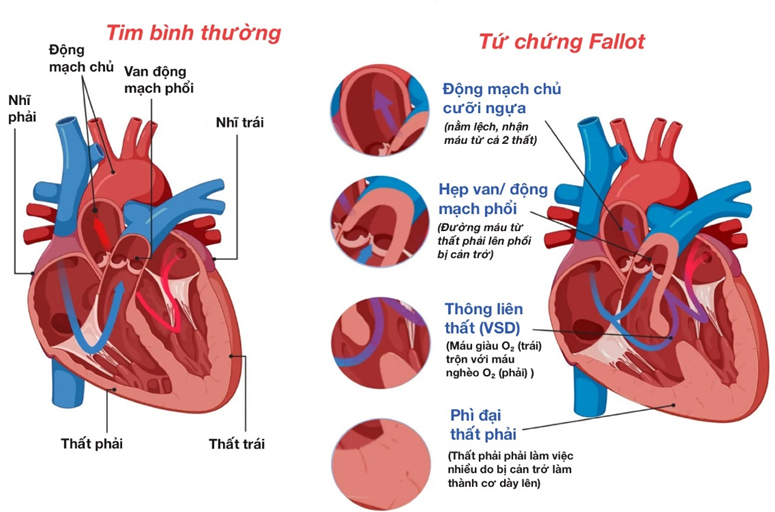 Hình minh họa tổng quan 4 đặc trưng bất thường giải phẫu trong Tứ chứng Fallot