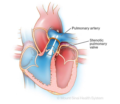 Hình minh họa cấu trúc tim với hẹp van động mạch phổi – một thành phần quan trọng trong Tứ chứng Fallot. Nguồn: Mount Sinai Health System. (n.d.). Pulmonary valve stenosis [Illustration]. Mount Sinai Health Library.