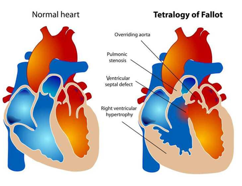 Hình minh họa so sánh giữa tim bình thường và tim trong Tetralogy of Fallot, trong đó nổi bật là phì đại thất phải. Nguồn: Centers for Disease Control and Prevention. (2024). Tetralogy of Fallot.