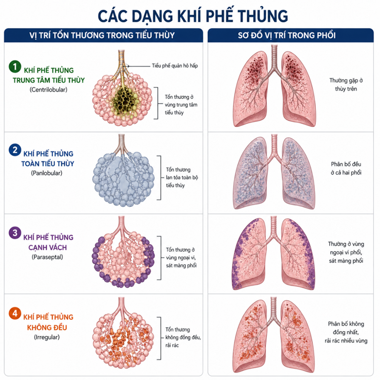 Hình ảnh tổng quát về các dạng Khí phế thủng