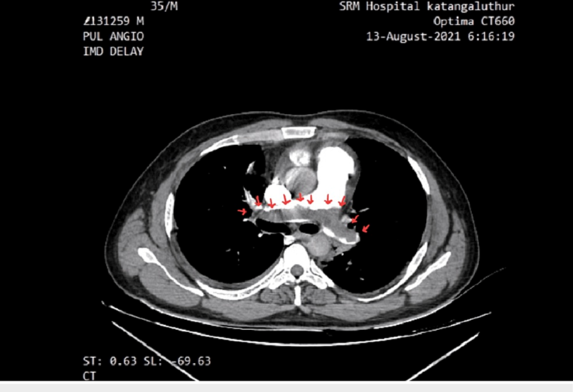 Hình CT cho thấy vùng khuyết thuốc trong động mạch phổi (mũi tên đỏ), biểu hiện của cục máu đông. Điều này làm cản trở dòng máu đến phổi → điển hình cho thuyên tắc phổi.
Nguồn: Abdo, Y. (n.d.). Computed tomography pulmonary embolism (CTPE) showing pulmonary artery embolus [Figure]. Researchgate
