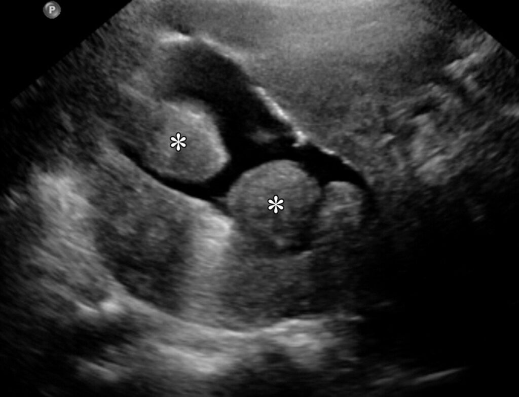 sieu am bom nuoc long tu cung minh hoa