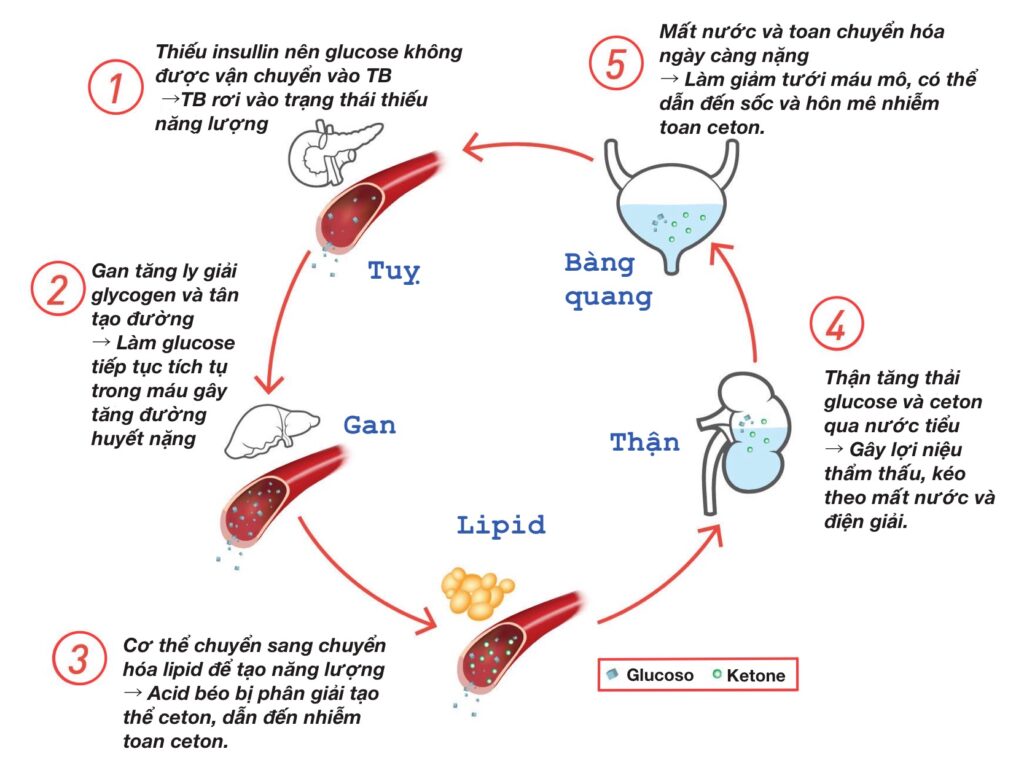 Hình ảnh mô tả tổng quan 6 giai đoạn trong cơ chế dẫn đến DKA