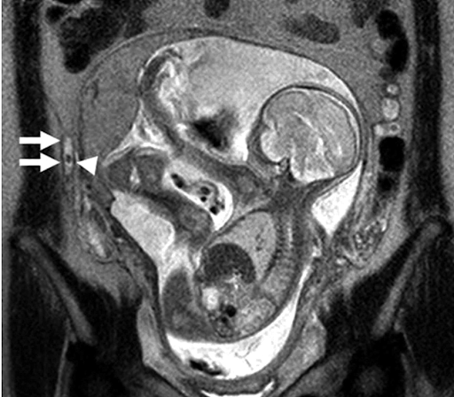 Thách thức trong chẩn đoán và chiến lược xử trí viêm ruột thừa cấp ở phụ nữ mang thai image 13
