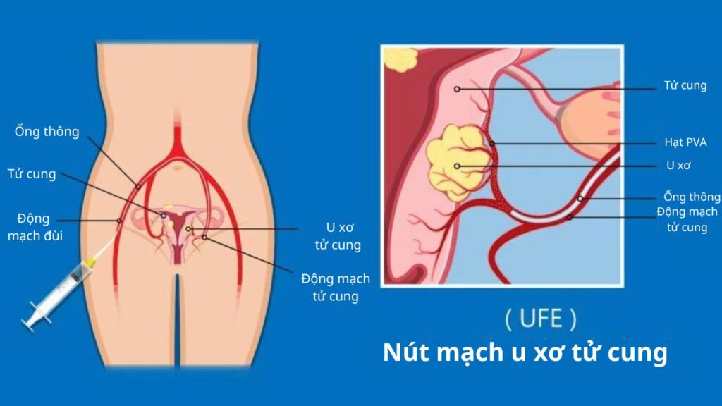 U xơ tử cung (phần 7): Các phương pháp điều trị ít và không xâm lấn nut mach u co tu cung 2