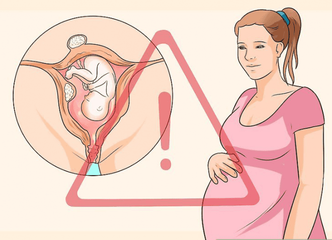 U xơ tử cung (phần 8): U xơ cơ tử cung và thai