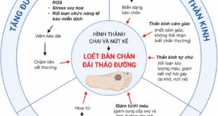 Hình ảnh minh họa tổng quan 3 yếu tố chính hình thành DFU và chi tiết hoạt động từng yếu tố