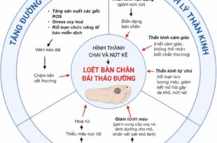 Hình ảnh minh họa tổng quan 3 yếu tố chính hình thành DFU và chi tiết hoạt động từng yếu tố
