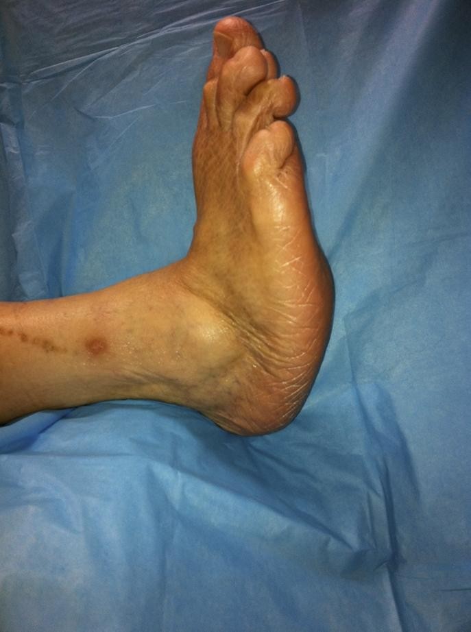 Cơ chế bệnh sinh của loét bàn chân đái tháo đường (DFU) ban chan charcot
