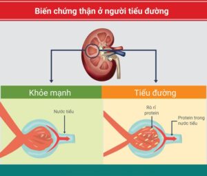 bien chung than dai thao duong tieu duongjpg 16626052525342053251826